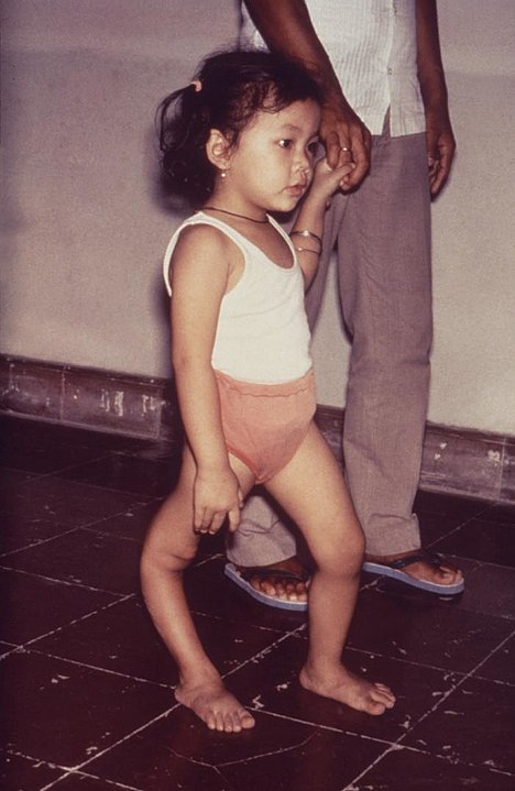 This child is displaying a deformity of her right leg due to polio caused by the poliovirus, an enterovirus member. After initial oropharyngeal inoculation, and multiplication, the virus enters the bloodstream, thereby, finding its way to the central nervous system, and infecting the motor neurons of the anterior horn of the spinal cord and within the brain itself.