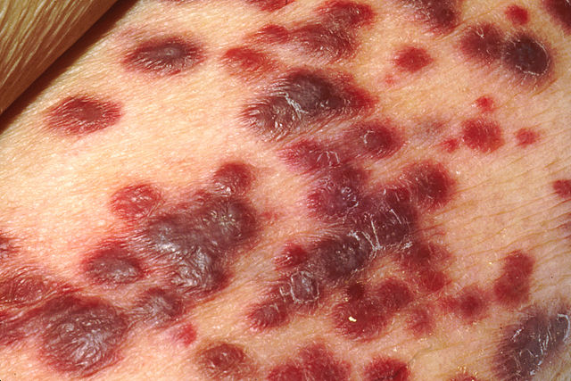 Kaposi's sarcoma on the skin of an AIDS patient.